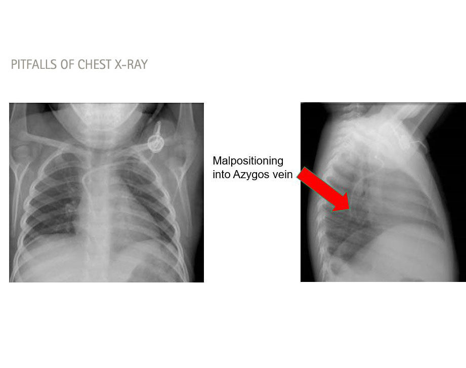 pitfalls of chest x-ray