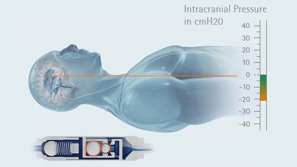 Graph intracranial pressure in the horizontal position