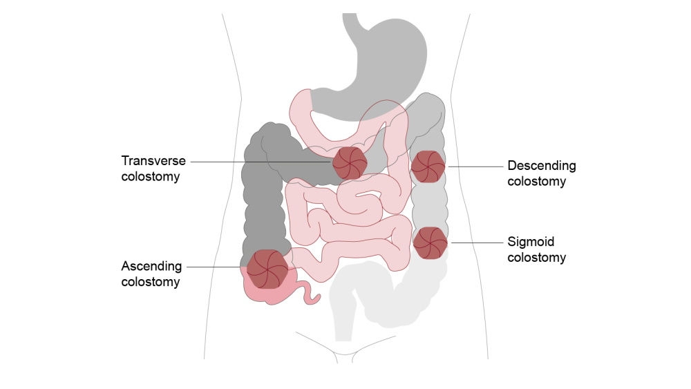 transverse, descending, ascending and sigmoid colostomy illustration