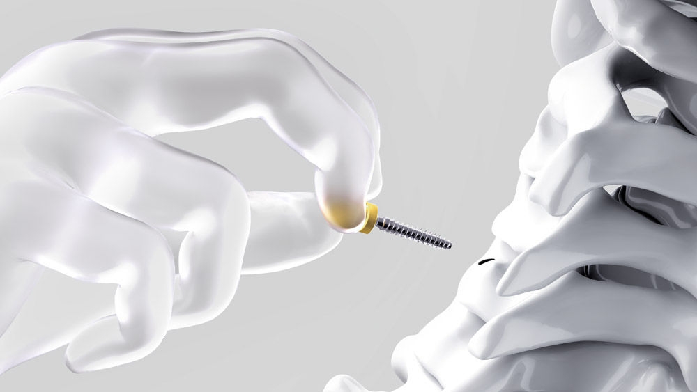  Illustration showing a hand holding an Ennovate® Cervical screw between the fingers and guiding it toward a cervical vertebra, indicating controlled insertion.