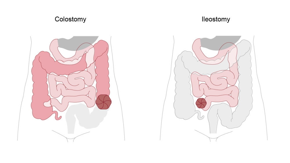 colostomy and ileostomy illustration