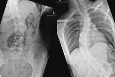 X-rays of clinical Ennovate® case on complex adolescent idiopathic scoliosis