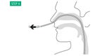 Illustration: Disconnect the gastric tube. The drain is now transnasally channelled. (!) Remove of the sponge only through the mouth and never through the nose. (!)