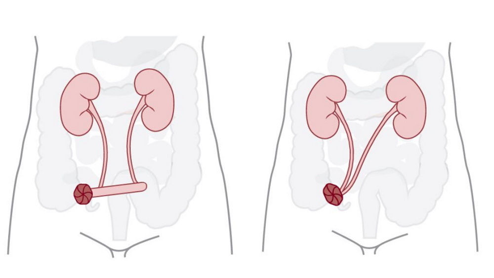 ileal condui and ureterostomy illustration