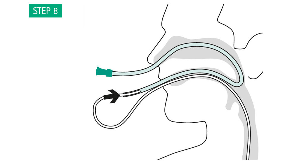 Illustration: Connect the drain to the gastric tube in front of the mouth. Pull the stomach tube together with the drain back through the nose.