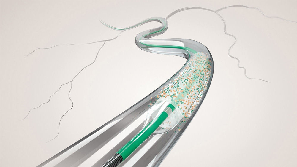 A coronary drug-coated balloon used in angioplasty of a calcified coronary artery lesion.