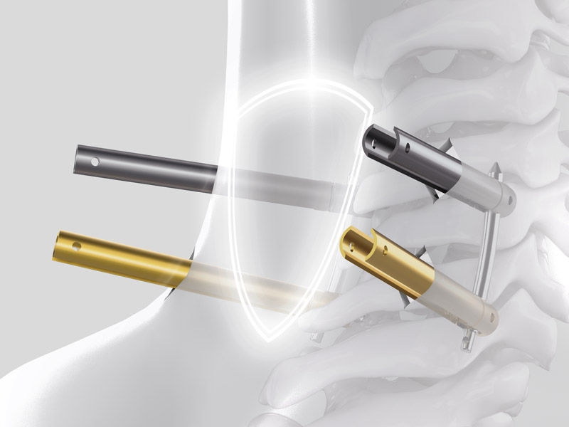  Illustration of a minimally invasive cervical spine procedure showing four screws positioned at the cervical vertebrae, with a central shield symbol representing the protective aspect of the minimally invasive approach.