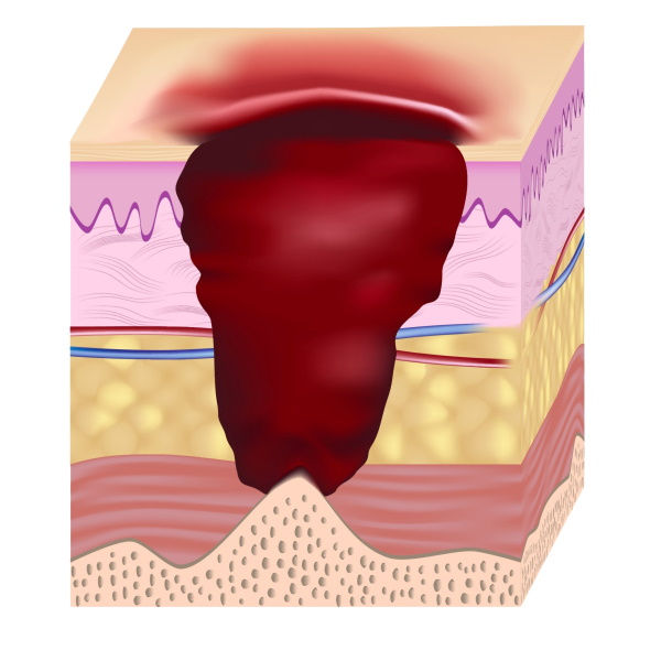 Illustration: Stage 4 pressure ulcer