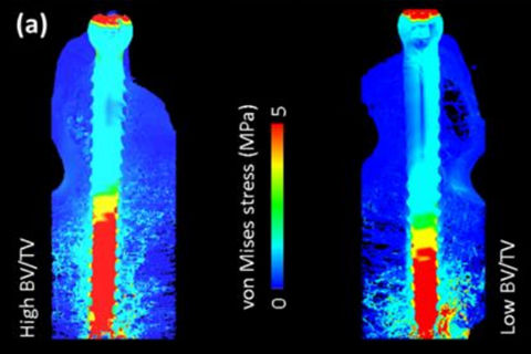 µFE Analysis of the pedicle-screw-bone-interface under different loading conditions