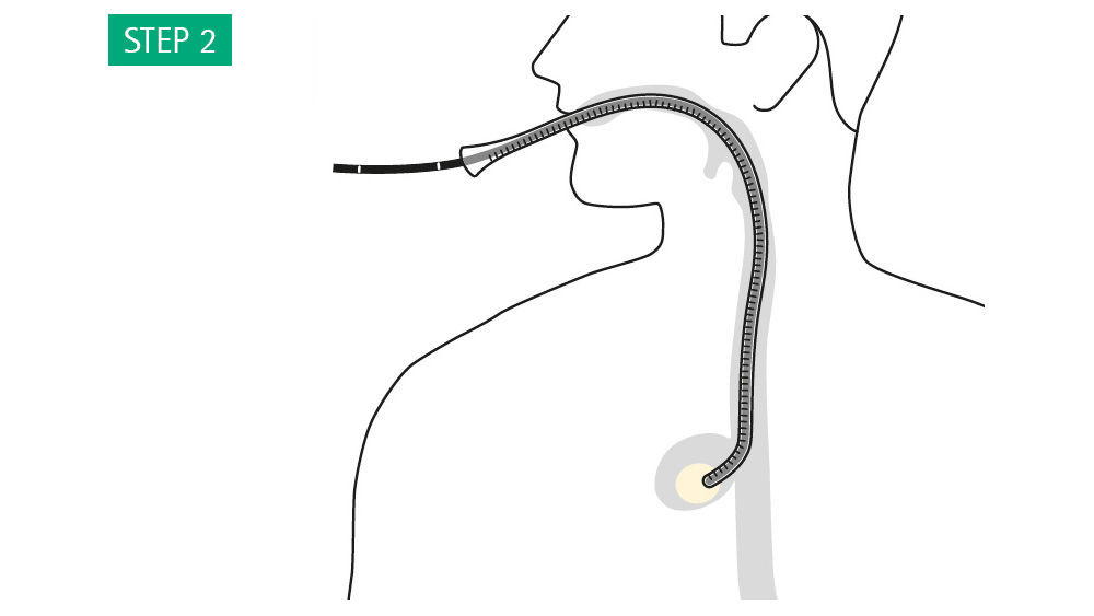 Illustration: Push the overtube over the endoscope and introduce it using the endoscope as a guide until the tapered end is near the end of the cavity, leaving enough space for the sponge to deploy.