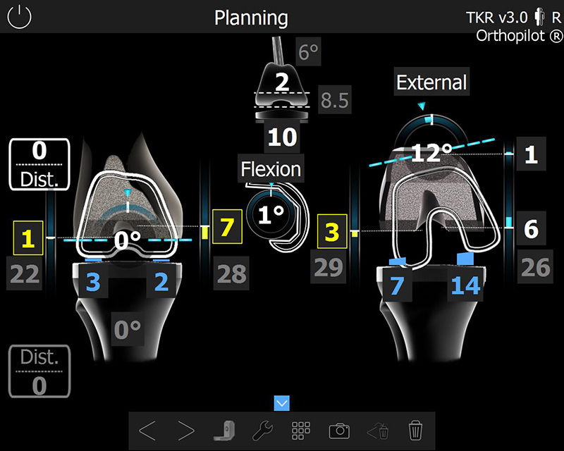 Screenshot of the OrthoPilot® TKR software – Femoral cut planning and augmentation planning