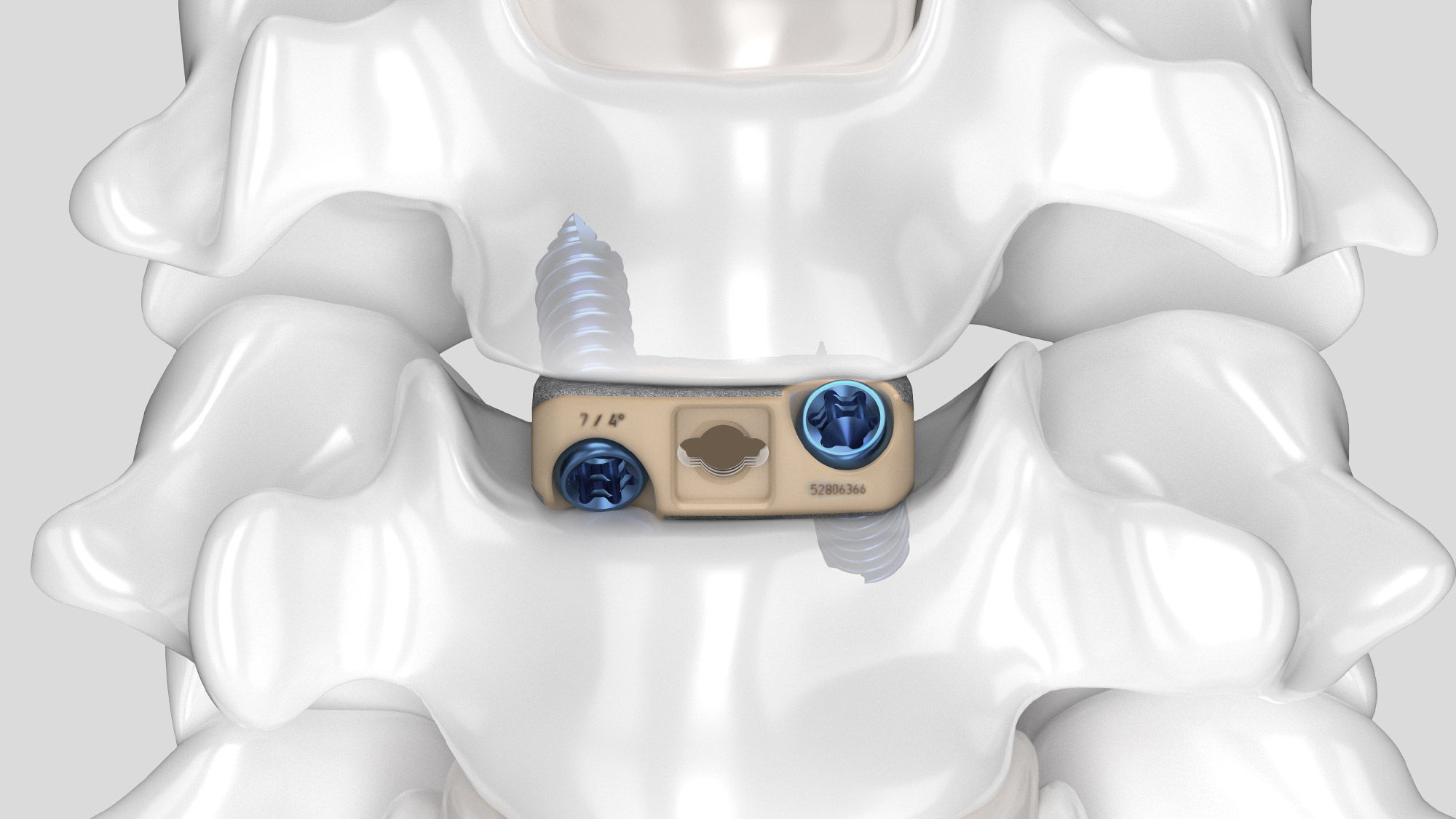 AESCULAP® PLASMAPOREXP® coated interbody fusion device