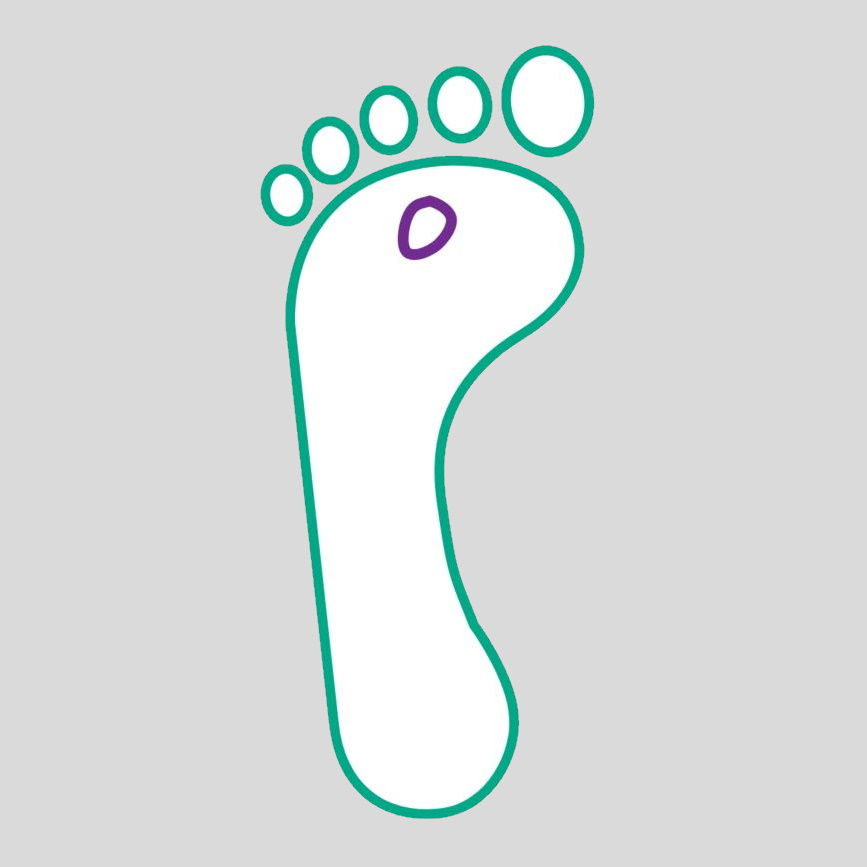 diabetic foot ulcer illustration grade 1