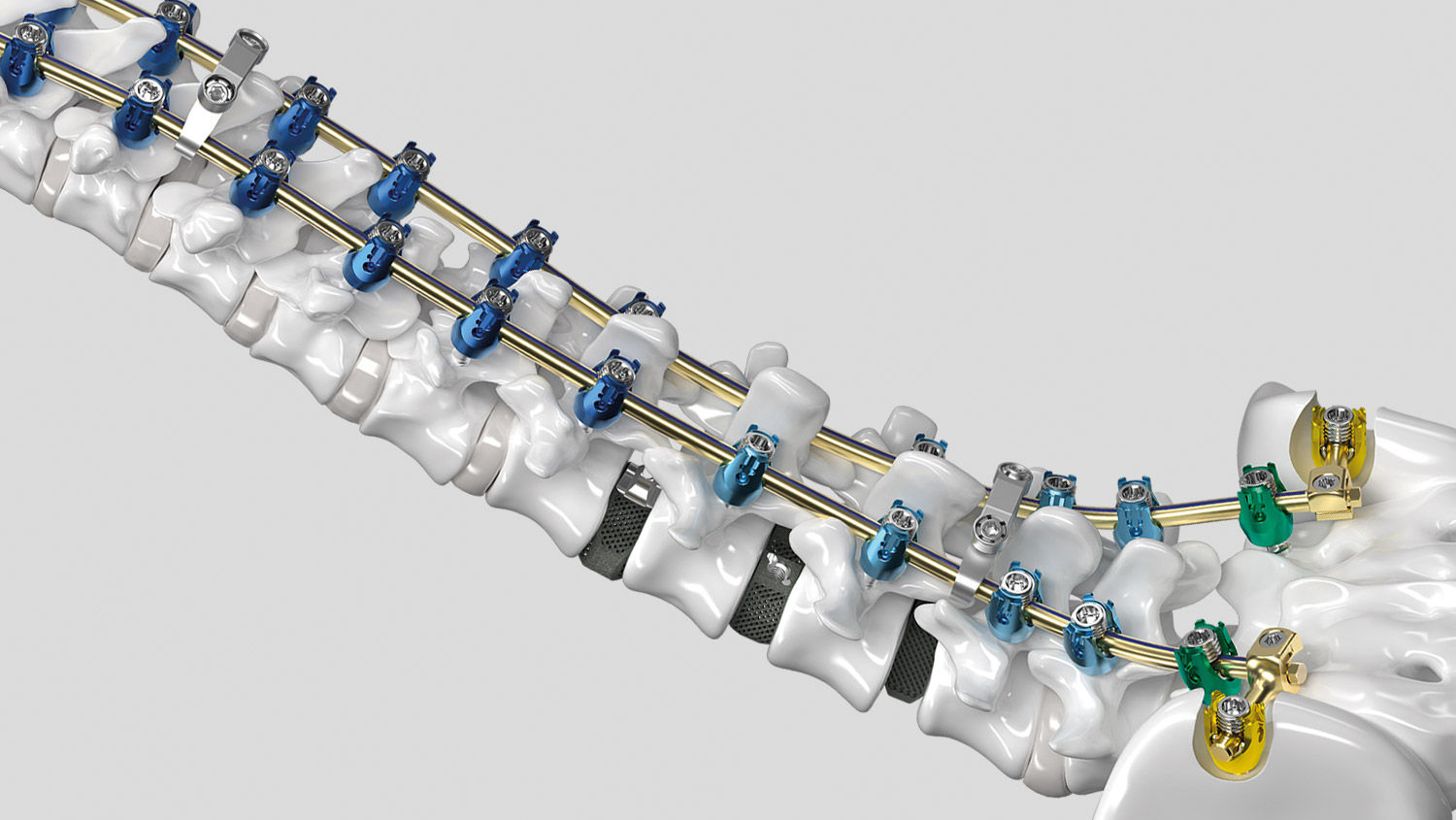 Ennovate® Thoracolumbar & Sacropelvic