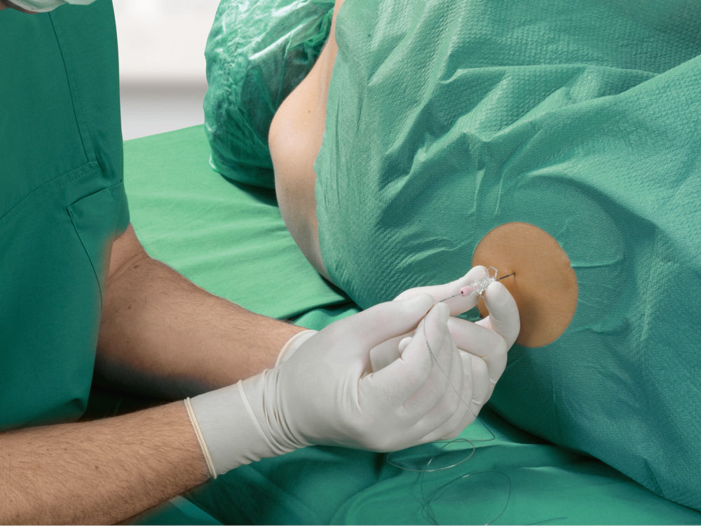 Puncture of the spinal cavity as part of a regional anesthetic - the anesthetist wears green surgical clothing and gloves the patient is lying on a green sheet covered with a surgical sheet and is wearing a surgical cap