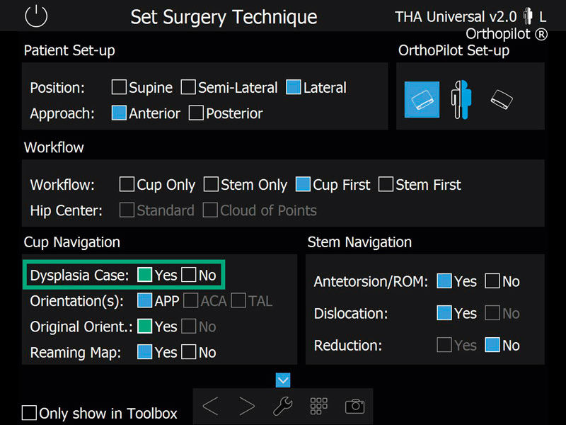 Screenshot THA Dysplasia navigation software hip arthroplasty
