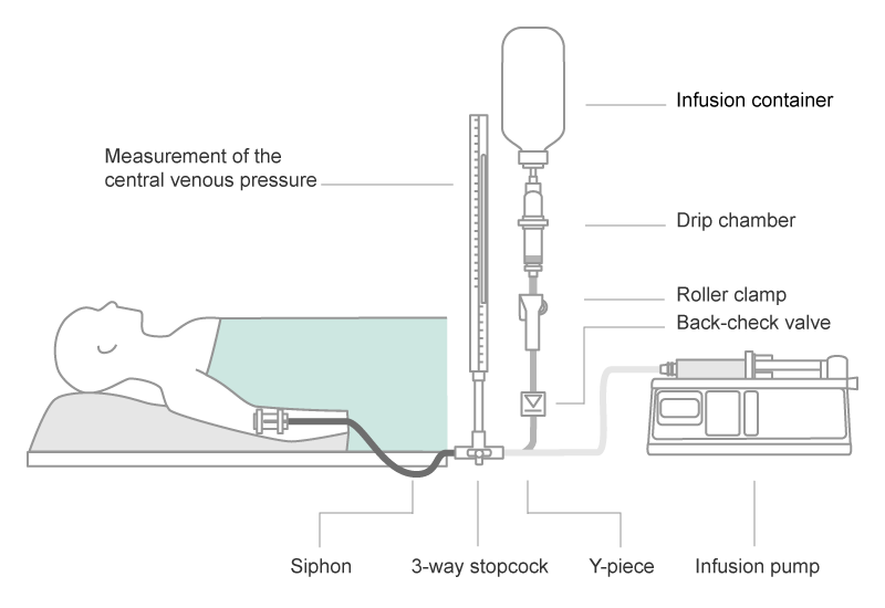 Air Embolism