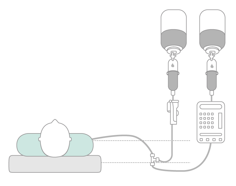 Parallel infusion with three-way stopcock of the bypass in ascending siphon tube.