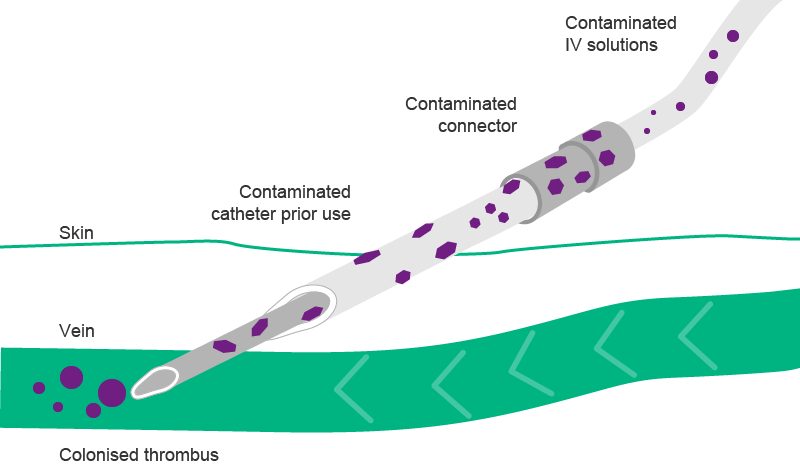 Illustration of Extra- and intraluminal route of contamination using a contaminated catheter.