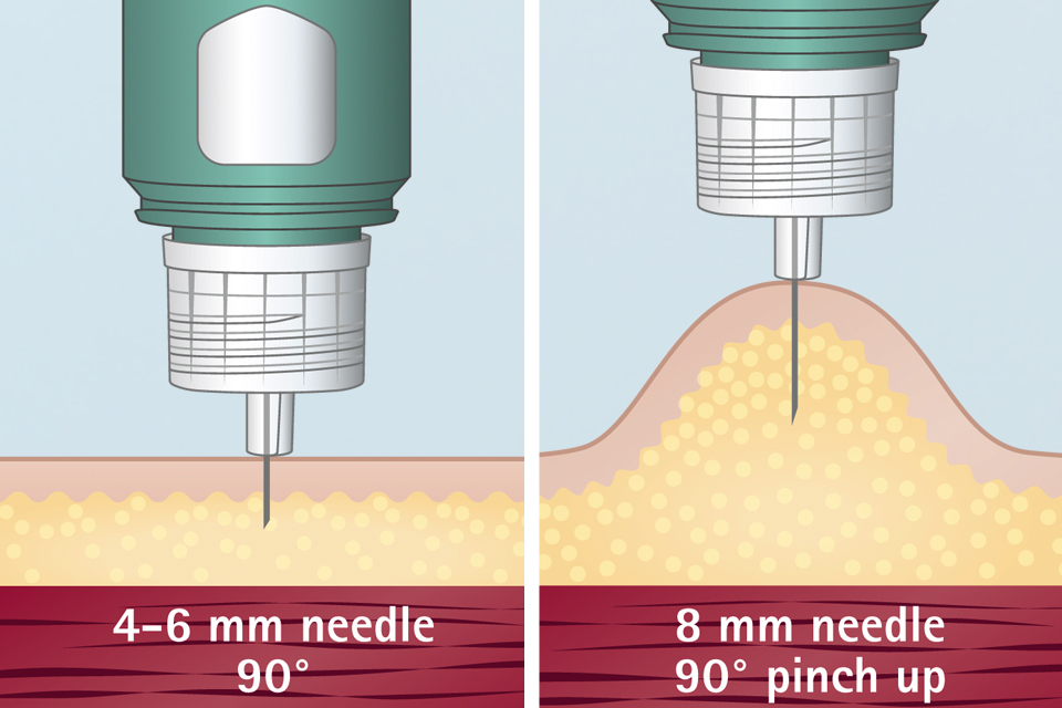 Multiple Needle Injection : Trigger Point Injection – RIGH