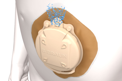 control bad stoma smell