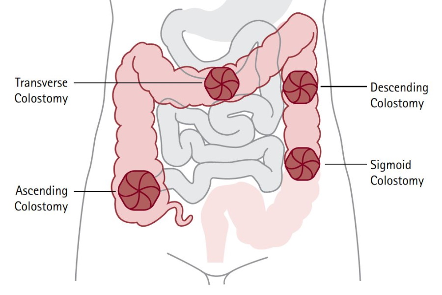 What Does A Healthy Colostomy Stoma Look Like at Samantha Mcgavin blog