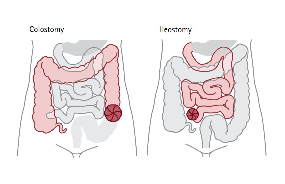 What is a stoma and which types of stoma exist