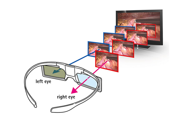 3D Technology in Laparoscopy