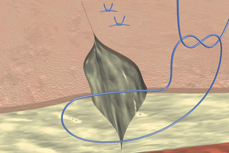 Suturing Techniques