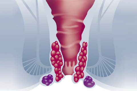 before and after stapled hemorrhoidectomy before and after stapled hemorrhoidectomy