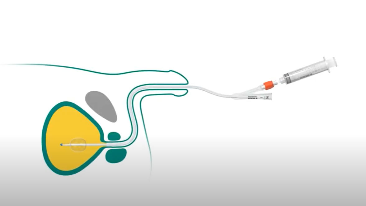 indwelling catheterization