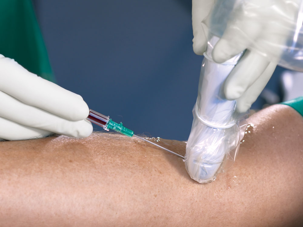 Healthcare worker wearing gloves is placing Introcan Safety® deep access cannula under ultrasound verification. Blood chamber is filled with blood.