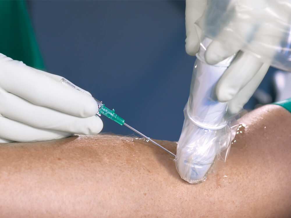 Ultrasound catheter insertion