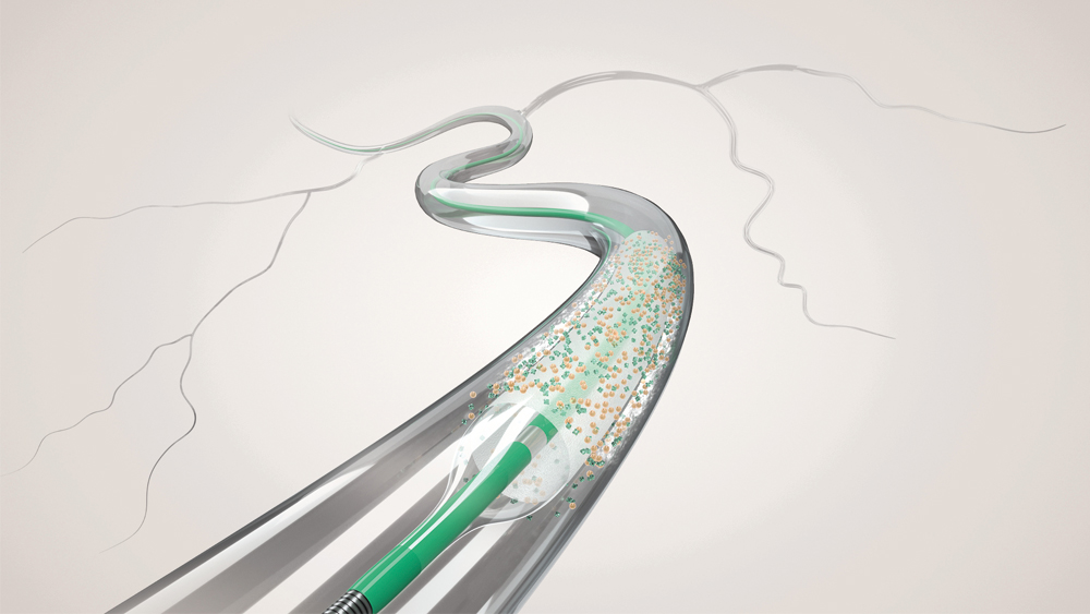 A coronary drug-coated balloon used in angioplasty of a calcified coronary artery lesion.