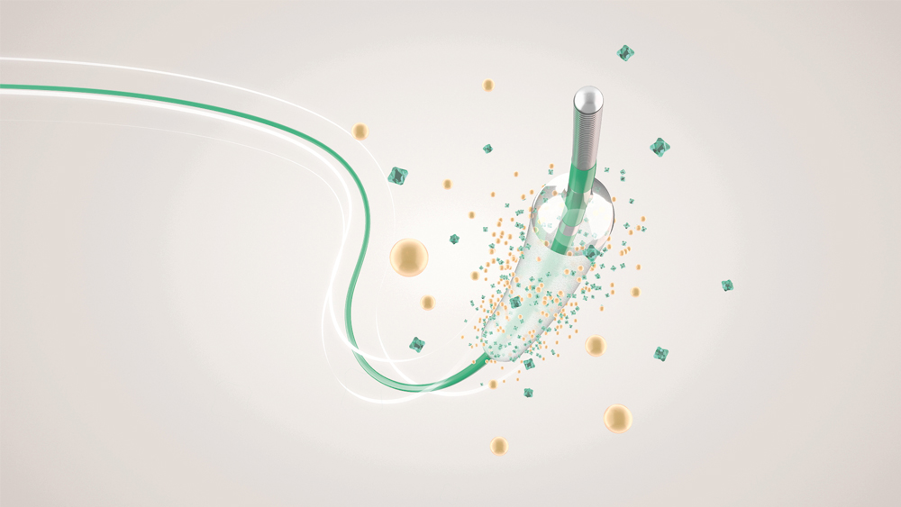 A coronary drug-coated balloon used in angioplasty of a calcified coronary artery lesion