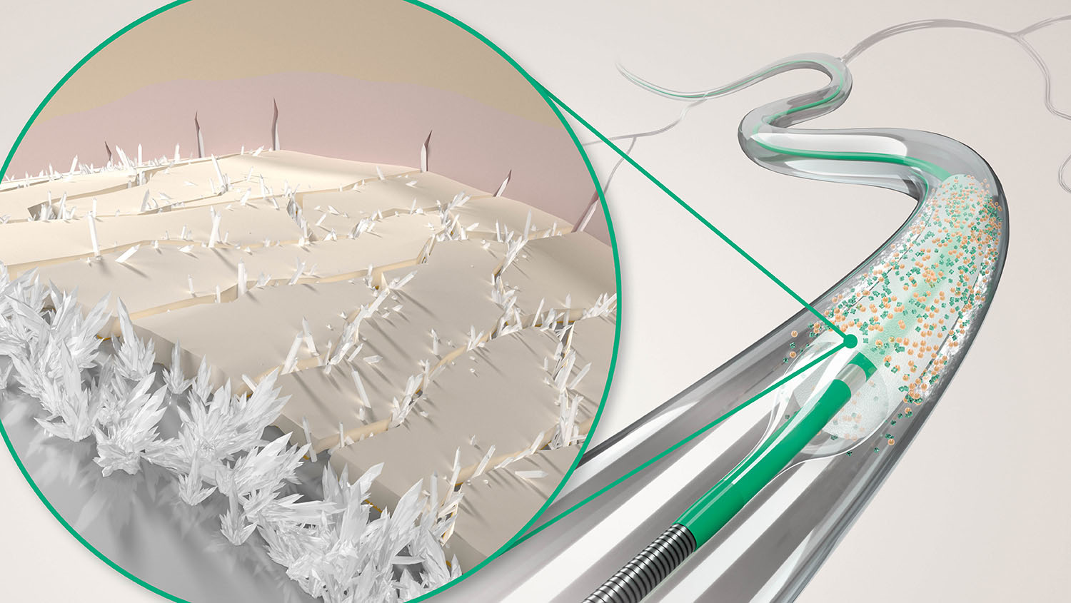 Coronary drug-coated balloon with crystalline coating that has fine, needle-shaped spikes.