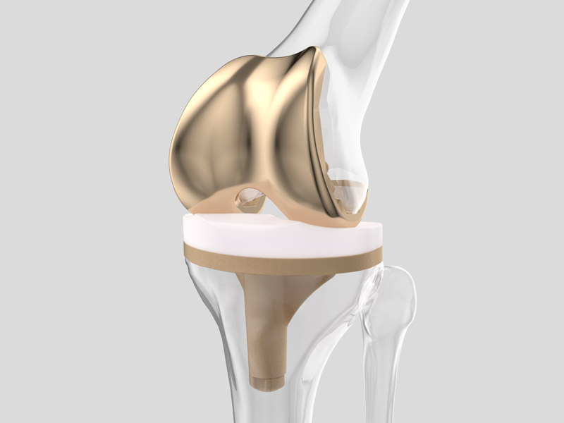 Innovative multilayer coating on a knee bone implant designed to enhance biocompatibility