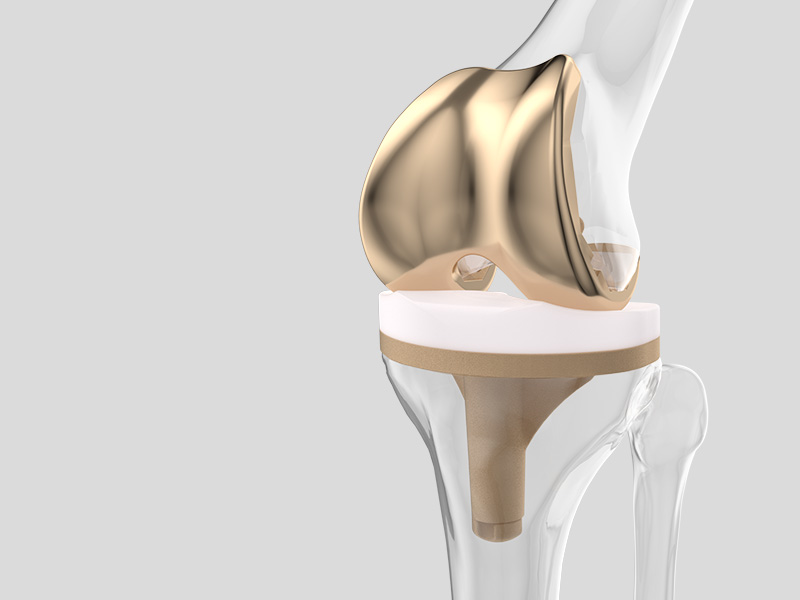 Innovative multilayer coating on a knee bone implant designed to enhance biocompatibility