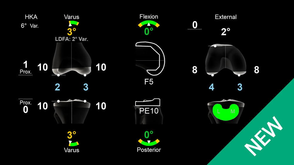 Screen of the OrthoPilot Elite navigation software Pheno4U TKA Level 1