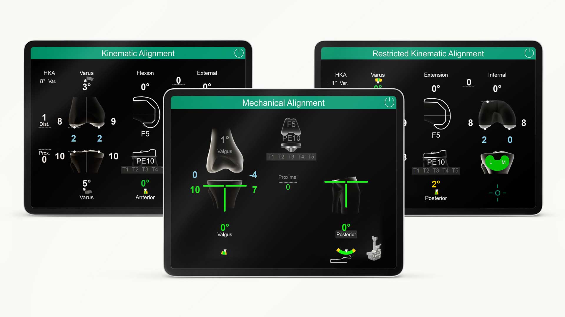 Three different OrthoPilot Elite screens showing the different software types: mechanical alignment, kinematic alignment and restricted kinematic alignment.
