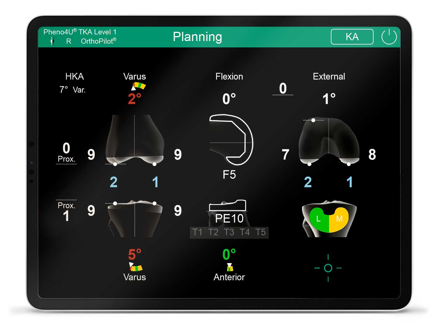 Screen of the OrthoPilot Elite navigation software Pheno4U TKA Level 1