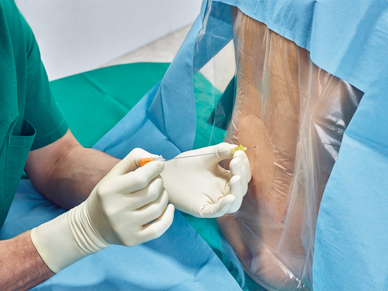 hands of an anesthesiologist threading an epidural catheter through the epidural needle placed in a patient back