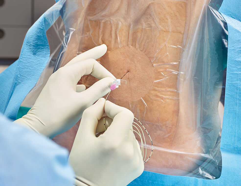 Gloved hands performing an epidural procedure, inserting a needle and catheter through a sterile drape into the patient's back
