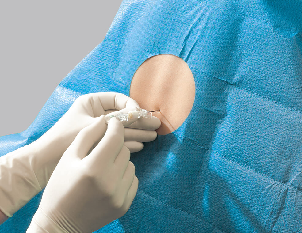 Medical procedure with gloved hands inserting a needle through a blue sterile drape into a patient's skin during preparation for injection or catheter placement