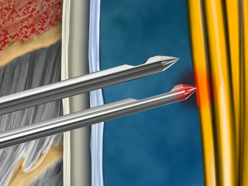 Two spinal needle tips positioned near tissue layers, with the lower needle highlighted in red close to a nerve bundle