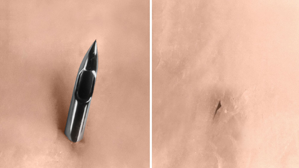 Close-up comparison of a sharp medical needle puncturing skin on the left and a small healed puncture mark on the right, both shown against a light skin-toned background