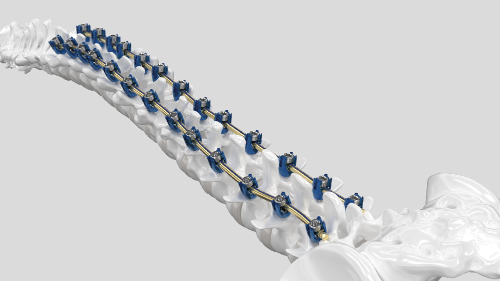 Spine model with Ennovate® Thoracolumbar & Sacropelvic