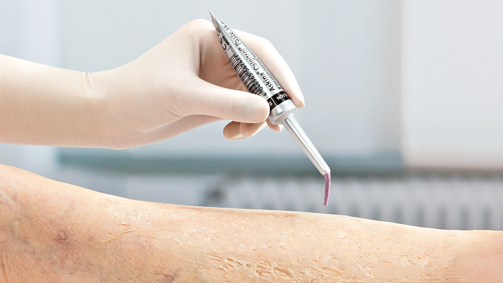 A hand with a glove holds a small calgitrol paste and the paste is applied to the skin