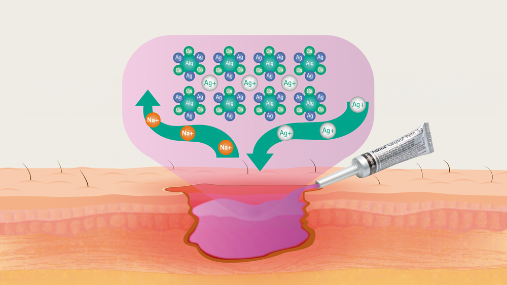 Illustration showing Askina Calgitrol Paste mode of action. The paste is being applied to a wound, highlighting the release of silver ions (Ag+). The diagram emphasizes the antimicrobial action of silver ions interacting with bacteria at the wound site, with labeled molecules and directional arrows indicating ion movement.