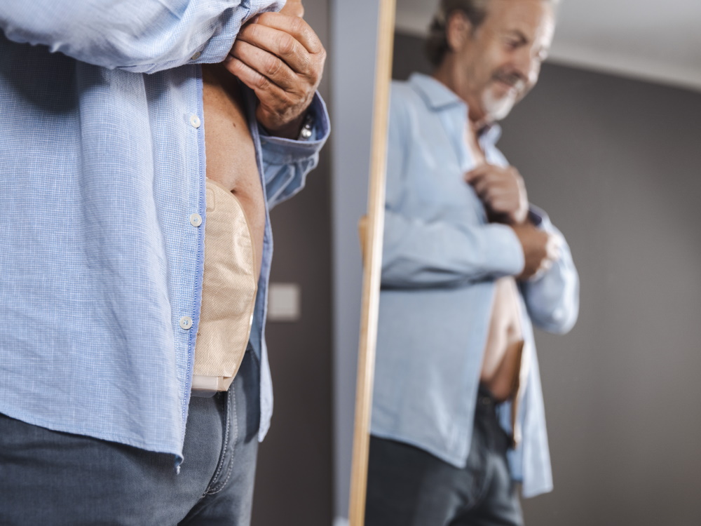 A middle-aged man with a stoma bag attached is standing in front of a mirror, buttoning his shirt